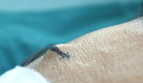 体检|医生眼里的6种“善良瘤”，确诊后先别慌，恶化概率很低