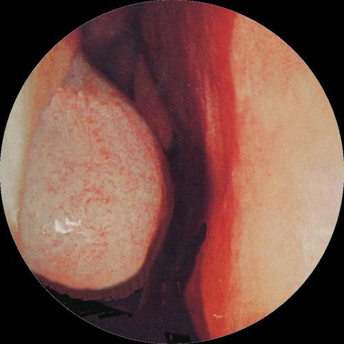 金魁九香油 金魁九香油科普:为什么鼻炎变成了鼻咽癌?不要忽视这几个症状