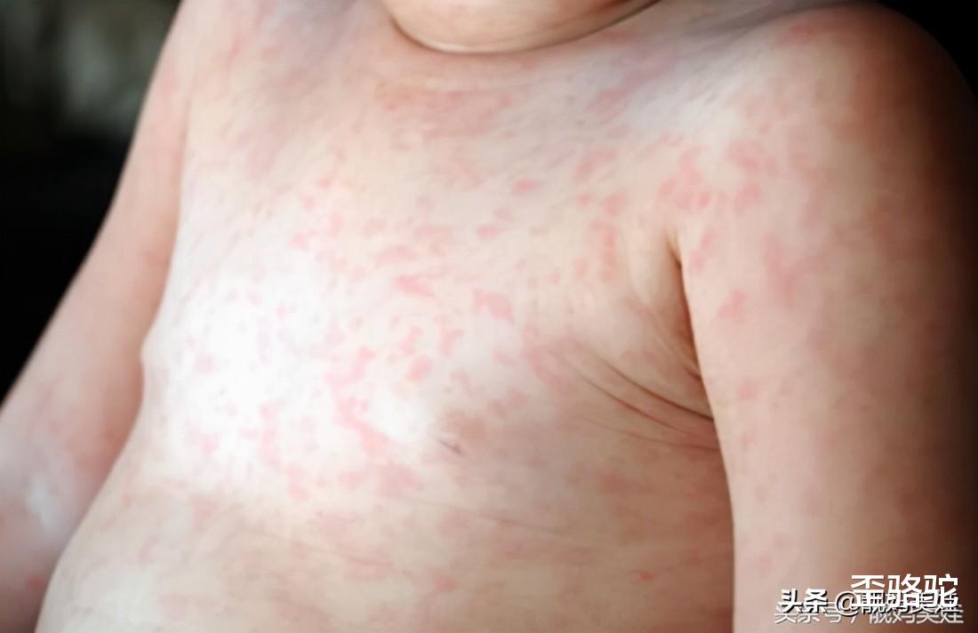 歪骆驼|6月女婴全身长斑高烧不退,救护车未等到就没了,妈妈太无知
