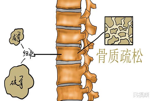 理疗|年纪越大骨头越脆，怎么回事？光顾着补钙还不够，推荐4个方法