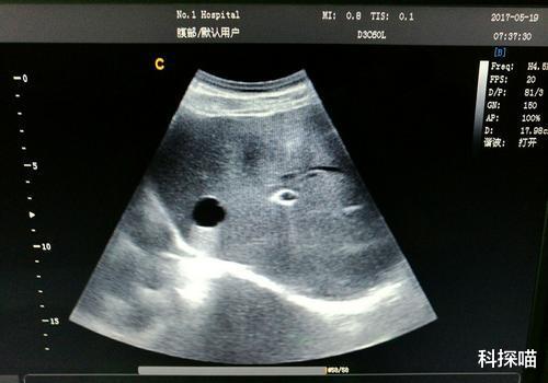 体检|体检时查出这4种病，或无需过度治疗，不要自己吓唬自己！