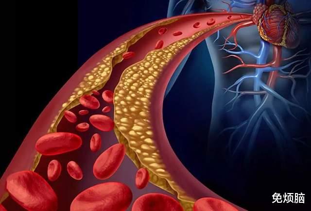 高血脂|高血脂患者，饮食要坚持一疏二控三消耗，避免并发症，才能更长寿