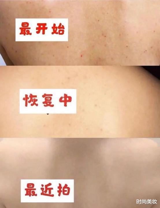 时尚美妆|刘亦菲也曾“跌下神坛”，只因后背长痘，长得好皮肤差是啥体验？