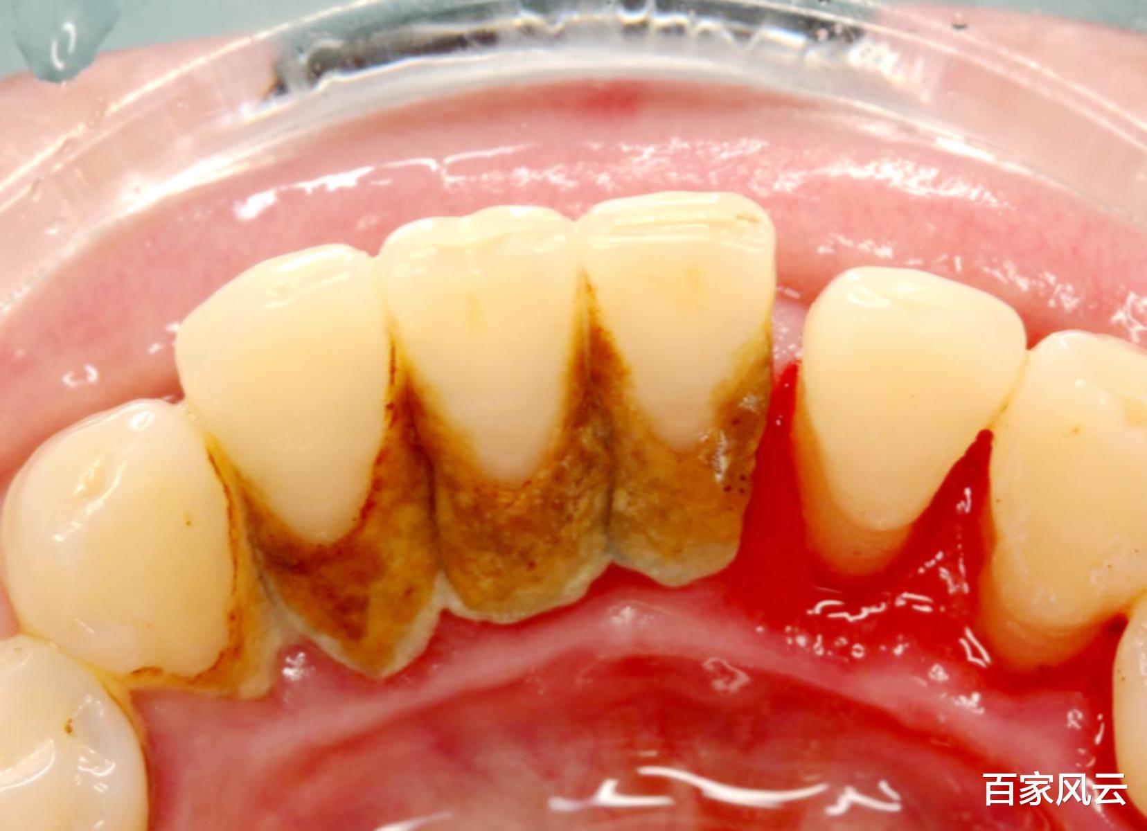 时尚好物官 牙齿长出“黄泥”又腥又臭，别拿手抠！牙医：教一小妙招，脏牙垢“蹭蹭”掉