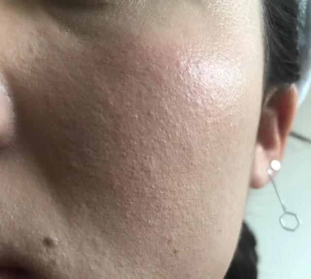 补水保湿 婚后皮肤缺水的女人，脸上有3个表现，一定要重视，不然后悔莫及