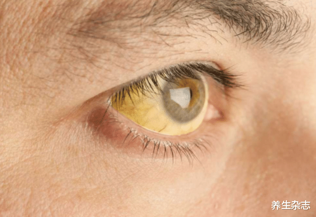 肝癌|数名专家联合呼吁：停止食用“1红2绿”，或是肝癌的“诱发器”，趁早远离