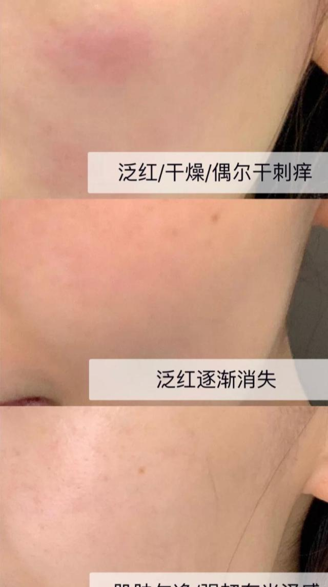 好物官|杭州女子为变美，自己注射“美白针”，结果“高烧不退”