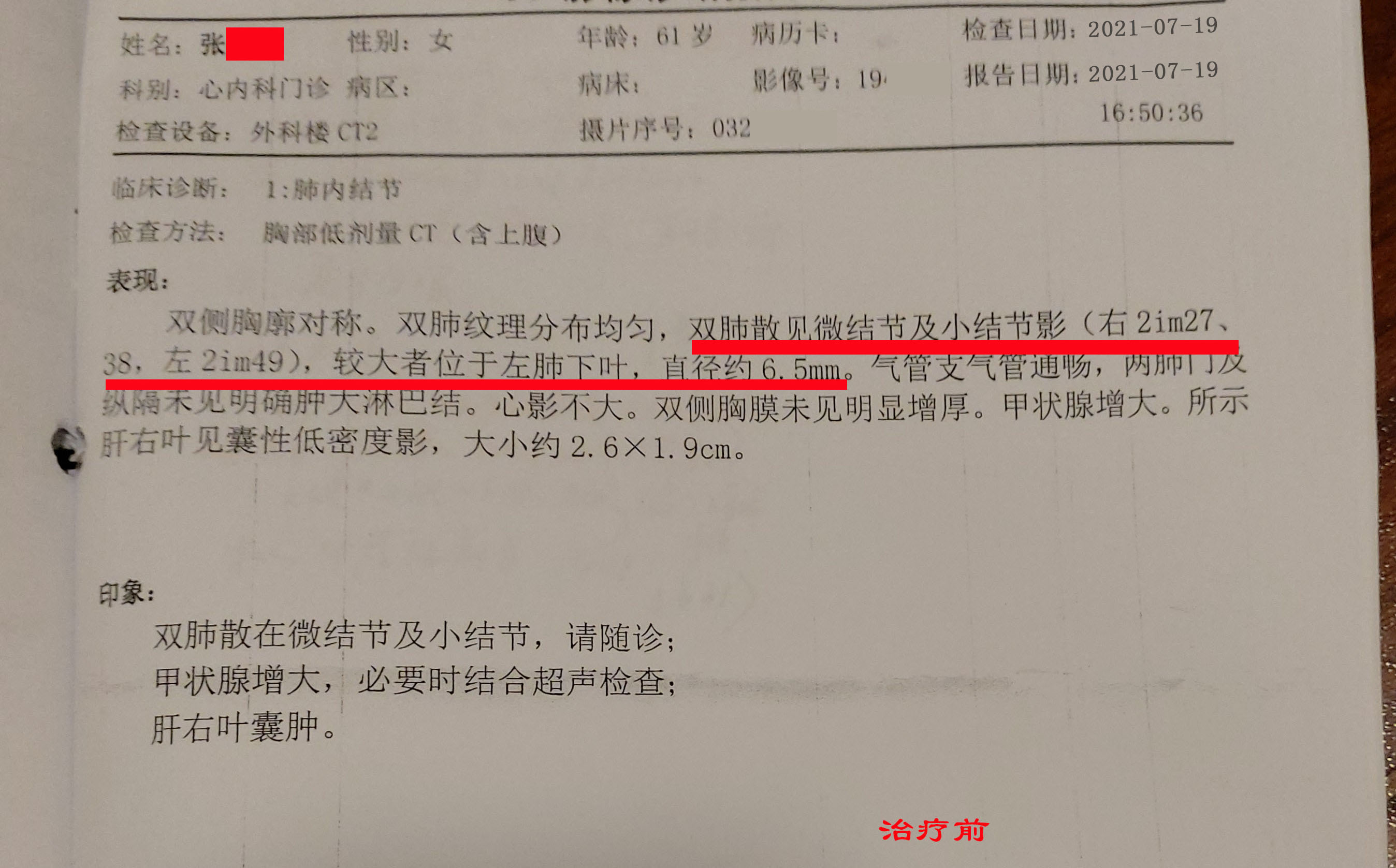 咳嗽|咳嗽有痰,不易咳出,爱发脾气,多是肺结节,中药调理4月后改善