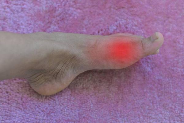 痛风|患上痛风时,脚部会有4种表现,若你有,要及时降尿酸了