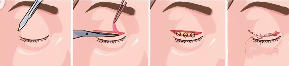 小美说美|妈生双眼皮怎么做