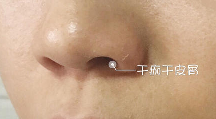 小玉护肤|深度剖析：水光针和长痘之间的某些关联因素!