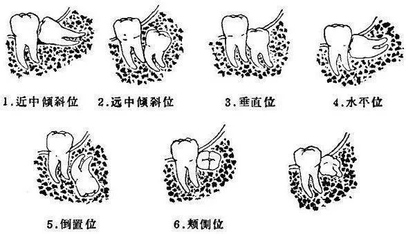 芽美口腔 芽美口腔：智齿到底要不要拔？拔完真的瘦脸吗？