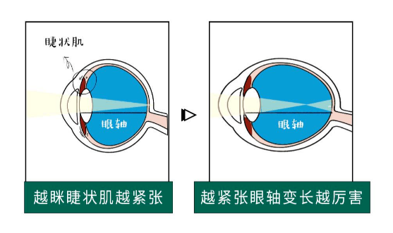 近视|那些近视不戴眼镜的人，最后都成什么样了？