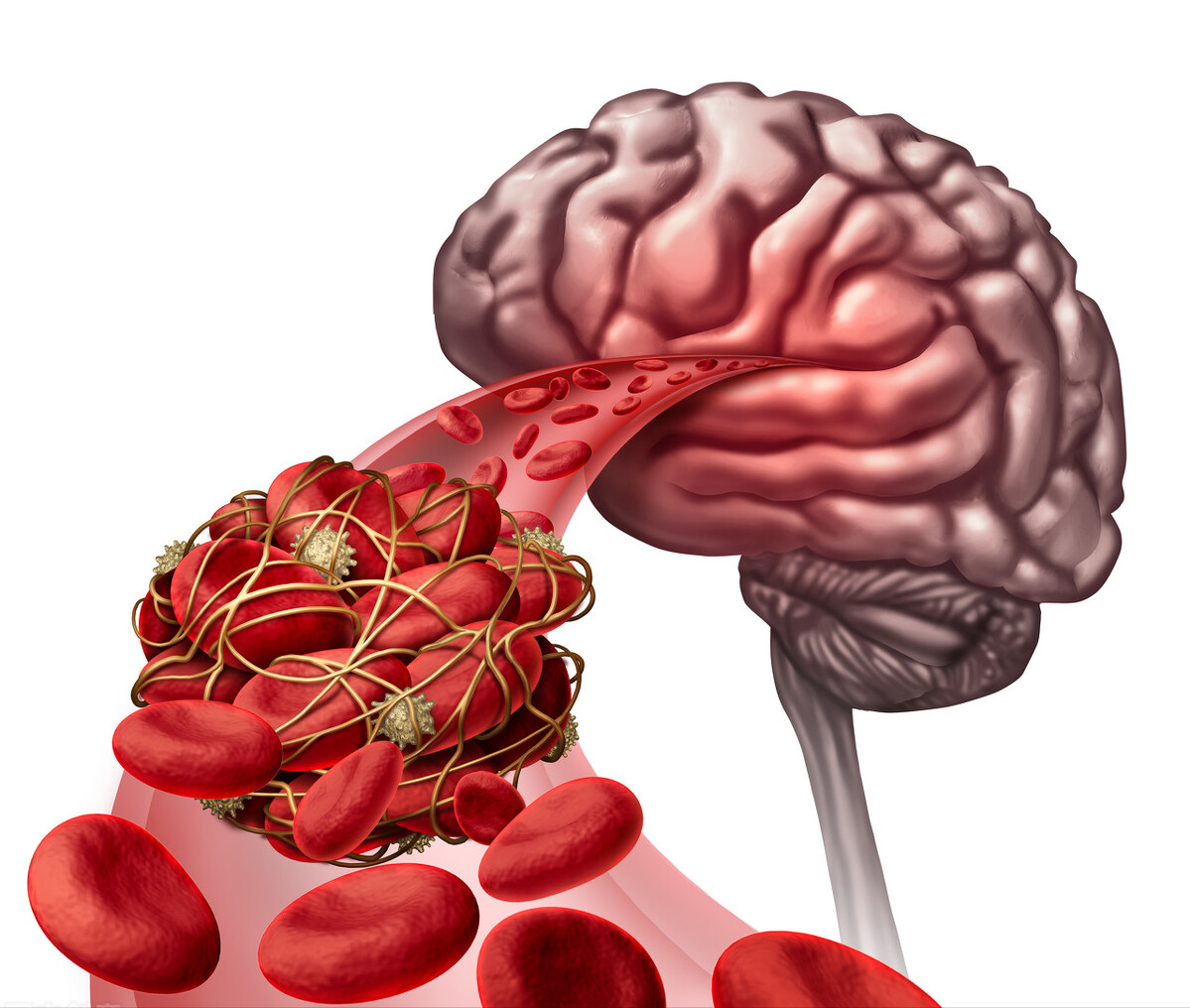中成药|3个中成药，为血管做次“大扫除”，改善瘀阻打通经络，心脑同治
