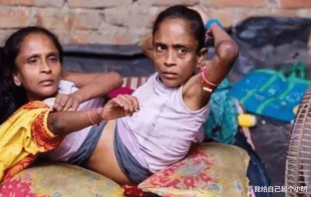  印度连体姐妹共用下肢，嫁给了同一位男子，还生了一个孩子
