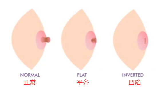 婴幼儿常识|国药育儿知识：女孩子乳头一个变化，年龄越大越当心！