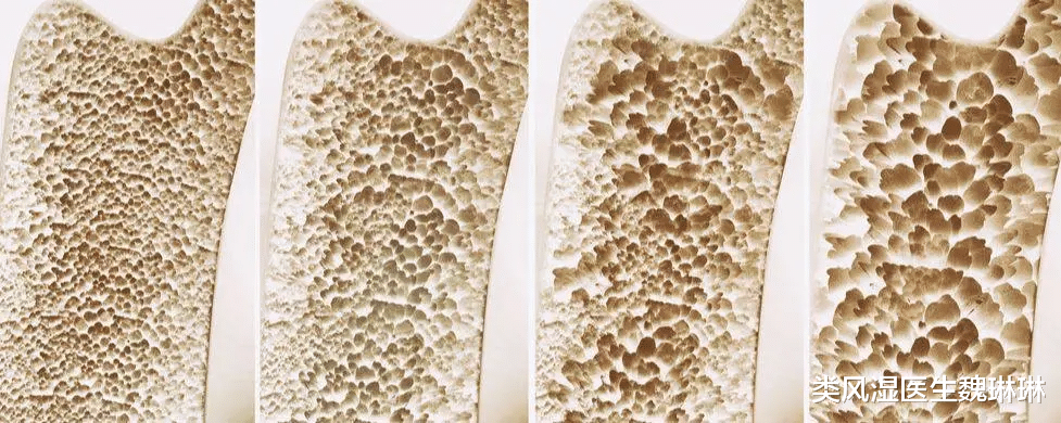 类风湿关节炎|导致类风湿患者残疾的“罪魁祸首”—骨破坏