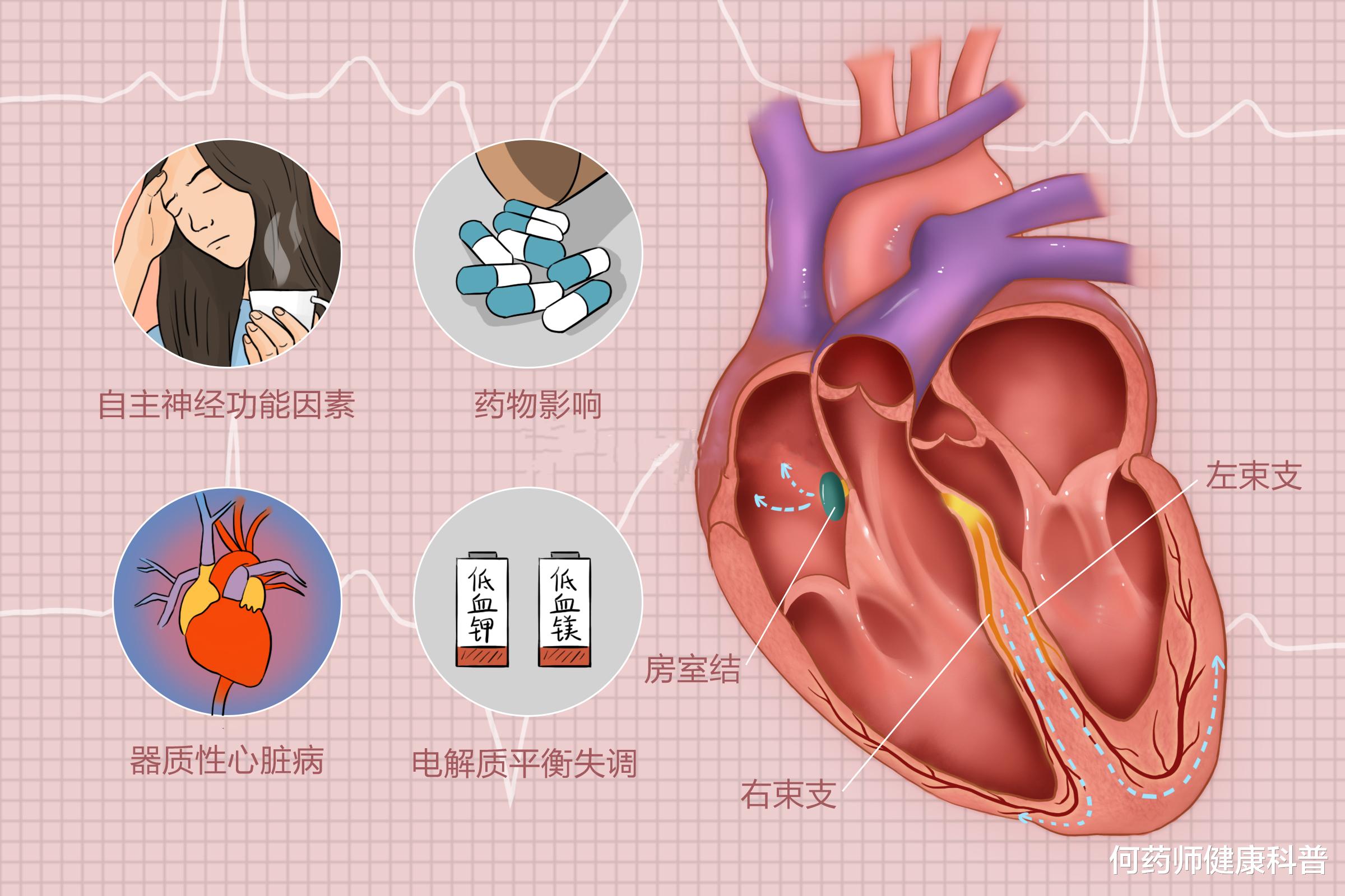 何药师健康科普|痰热扰心、阴虚火旺型室性早搏，可用什么中成药？临床药师说出实情