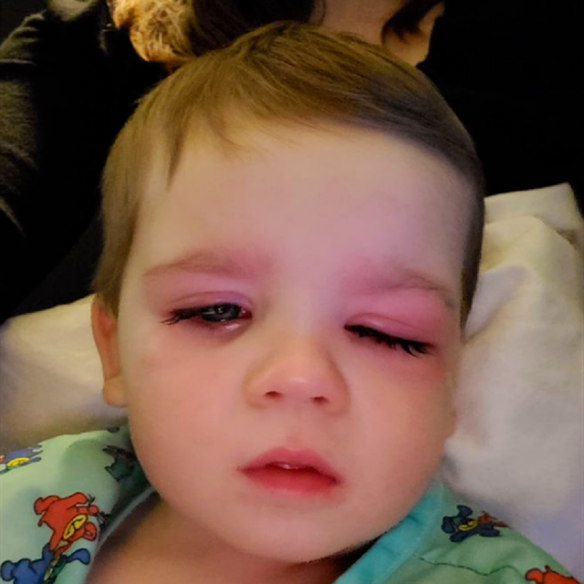 西红柿妈妈|外国2岁男宝因一只小黄鸭差点“失去光明”:儿童用品隐患要警惕