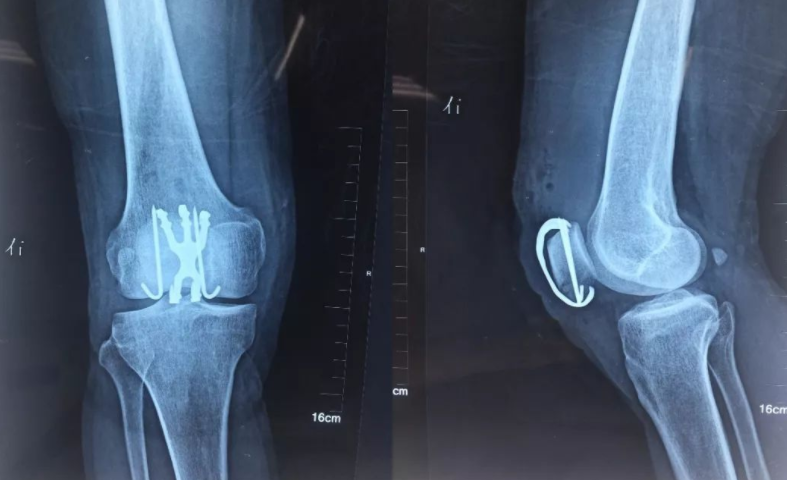 骨质疏松|多名院士联合声明：停止食用“1菜”，比抽烟喝酒还伤骨，别再成袋往家买