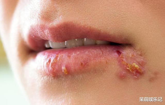 排毒|嘴上长泡是身体在排毒吗？或许是暗示了这几个问题，别忽视