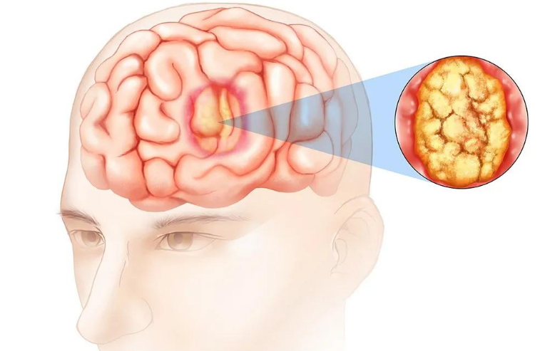 亚西亚健康网|知识科普：何为胶质瘤，它的分类知多少？