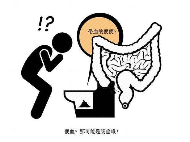 结肠癌|结肠癌早期，身体会有3个显著“变化”，发现一个，也要及时就医