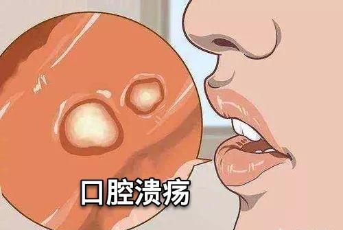 墨羽青春穿搭札记|经常口腔溃疡可以怎么缓解？