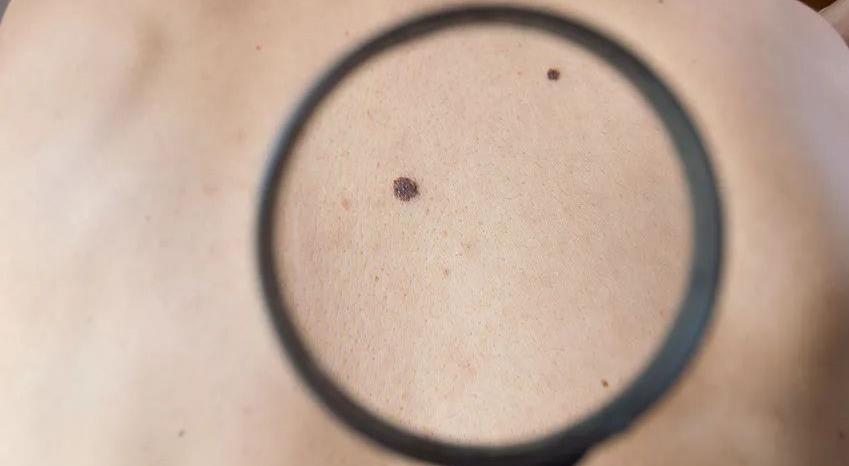 黑色素瘤|痣也可能会癌变！什么样的痣易“癌变”？长在这个部位的痣要注意