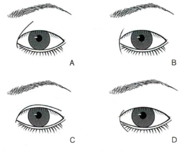 史迎军眼整形|史迎军眼整形 |坐双眼皮，一定要开内眼角吗？