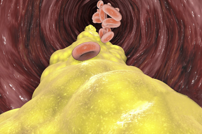 甘油|降脂“冠军”已公布，不是大蒜，你若爱吃，甘油三酯稳降