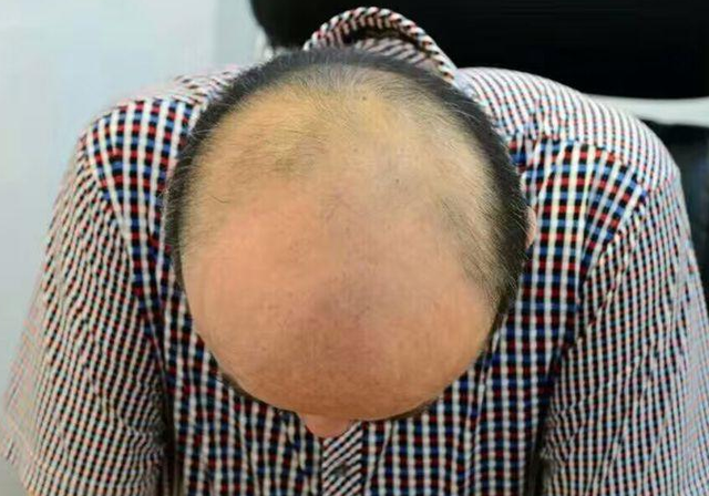 秃头|古芳栢草：头顶头发少就是秃头？这些秃头情况要分清！