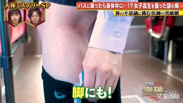 医生|日本女学生搭公车时出红疹昏迷不醒，医生发现她对“振动过敏”