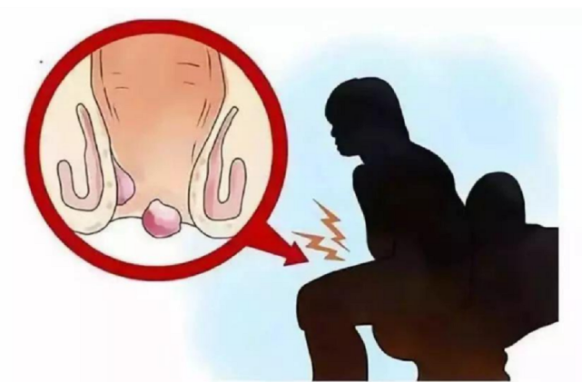 五千留风港|怎么让痔疮肉球缩回去？2021最值得囤的4款痔疮膏，绝对好用！