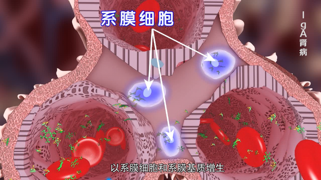 肾病之友|顽固性蛋白尿、复发性蛋白尿，如何解决？