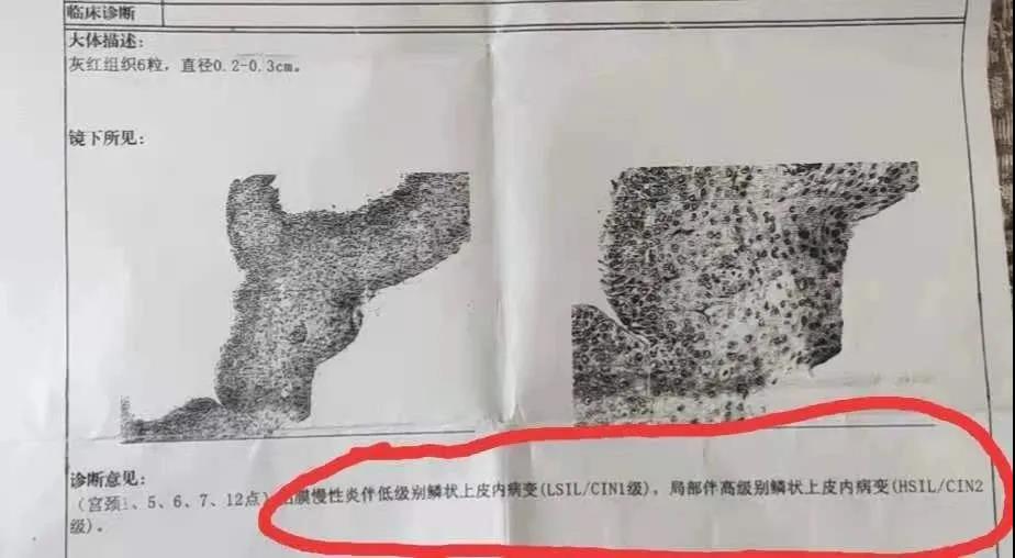 陈胖胖哦|宫颈癌前病变不是癌，及时干预最重要！