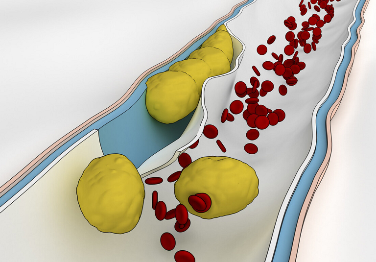 降血脂|血液“稀释剂”已找到,不是木耳,没事随便吃点,降血脂养护血管