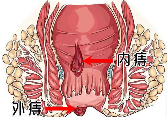 球探铭老师|小菊花饱受摧残之后的血泪教训！痔疮膏一定要选择适合自己的!