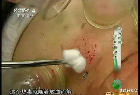 艾蓬轩艾灸|“蛇盘腰”调理建议！！