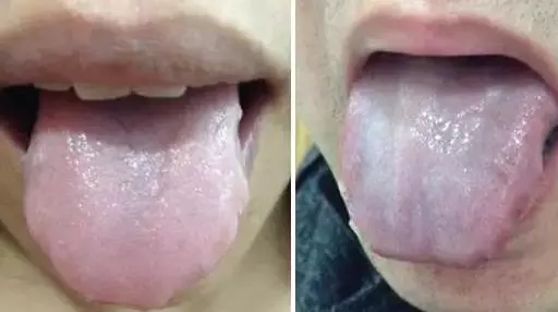 山楂|舌苔辨识9种中医体质，有配图！