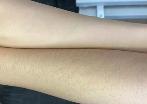 铠甲护士 为何有的女性体毛很旺盛，有的却“光秃秃”的？一起来看一下