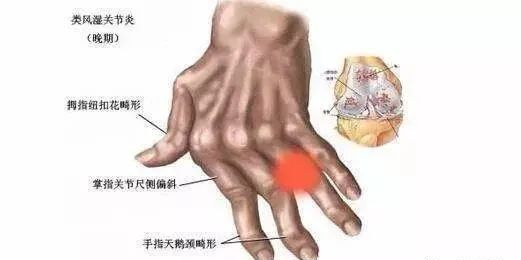类风湿关节炎|风湿性关节炎和类风湿性关节炎的区别【中国医学传播网】
