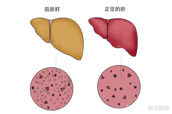 肝脏|42岁大哥喝酒20年，肝脏依然健康柔软，医生：酒后3习惯值得学习