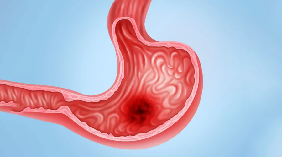 胃黏膜|阴虚亏损,则百病缠身,快速了解何为“阴虚症”。