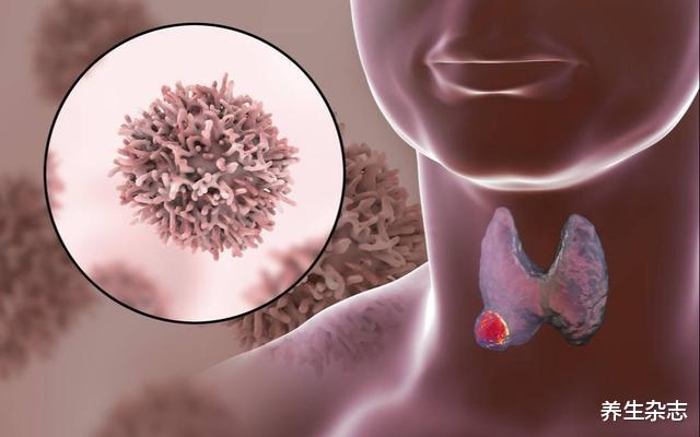 甲状腺|甲状腺不好,3种表现藏不住,希望你都不占,3类食物可“软化”结节