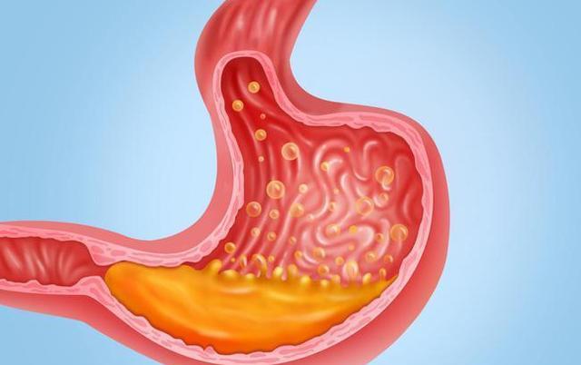痛经|喝粥、吃面条就能养胃吗?医生:保护胃黏膜,谨记“4少、3坚持”