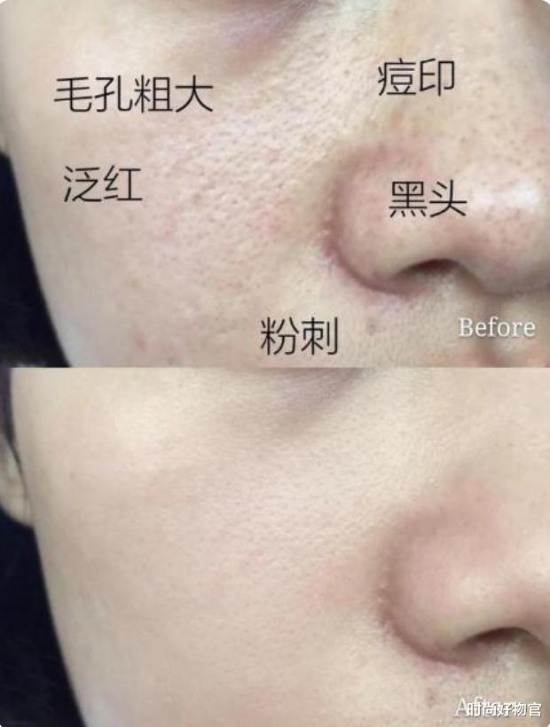 螨虫|提醒女生：夏天是螨虫高发期，护肤前要先除螨，不然既无效又伤肤