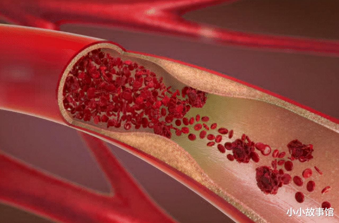 小小故事馆|转告家人：厨房2种调料是脑梗的“催化剂”，尽量少往菜里放