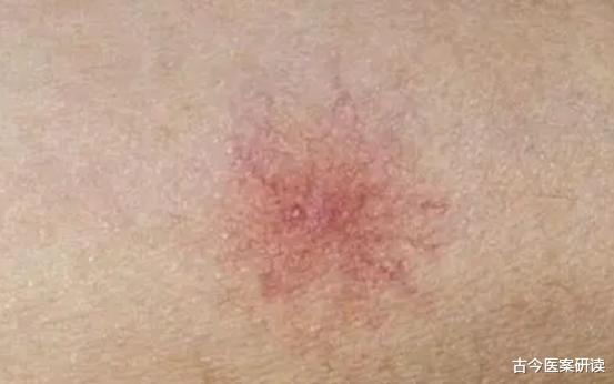 肝脏|肝癌缠身，面部先知！医院：无论男女，面部3异常，或是肝脏在“求救”