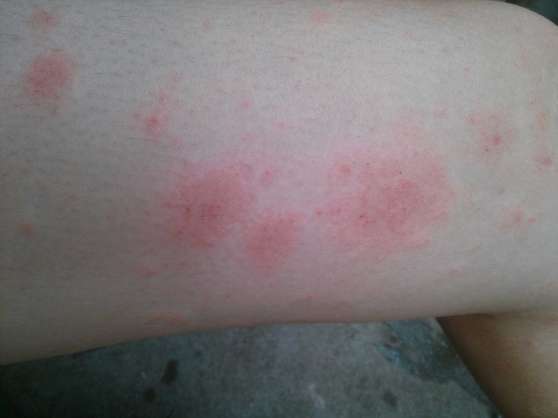 皮肤过敏|年轻白领错把艾滋病当成皮肤过敏，提示：皮肤出现3大异常需警惕